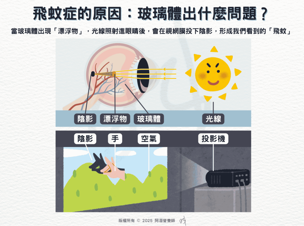飛蚊症的原因：玻璃體出什麼問題？